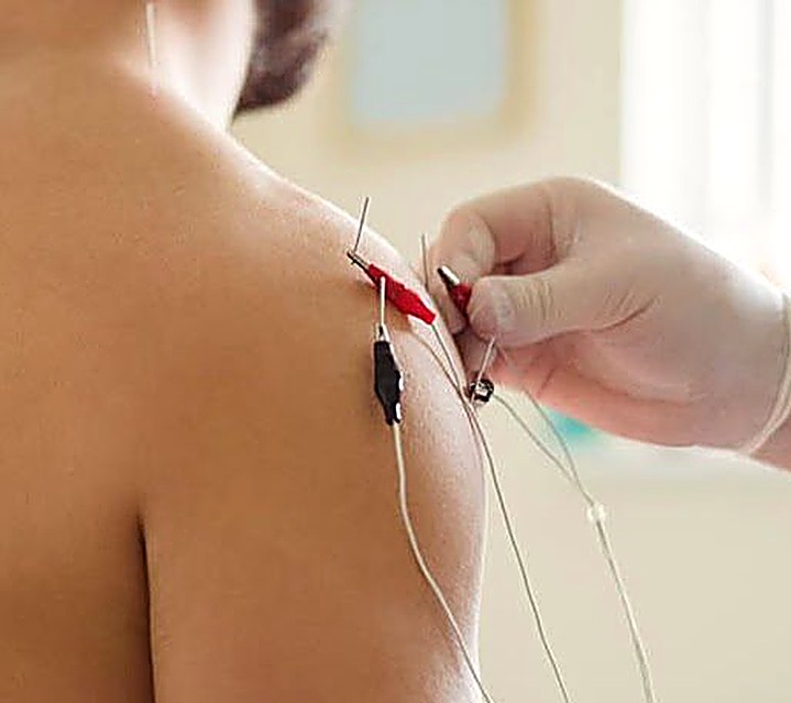 Dry needling treatment with electrical stimulation leads at Wellness Collaborative